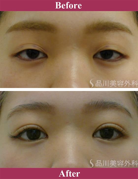 二重術ナチュラル法 症例写真【画像】