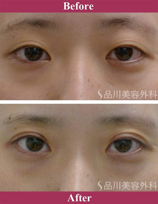 二重術切開法 症例写真【画像】