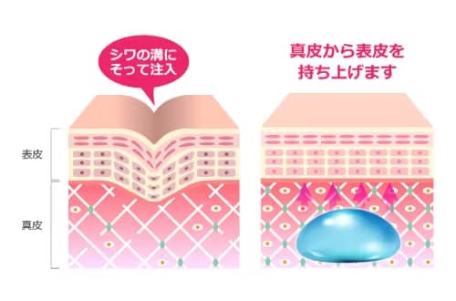 ヒアルロン酸注射（注入）とは？