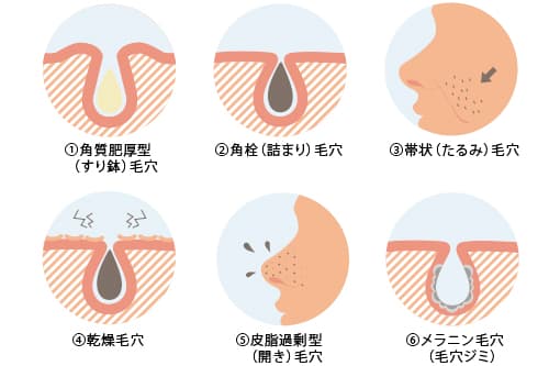 全部で６種類！あなたの毛穴はどのタイプ？