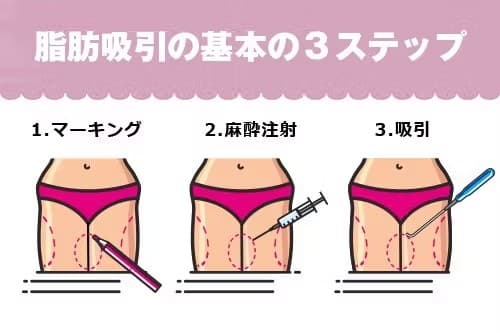 脂肪吸引の3ステップ 1.マーキング 2.麻酔注射 3.吸引