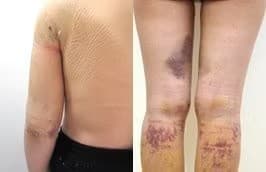 【脂肪吸引のチェックポイント2】ダウンタイムを確保できるか？