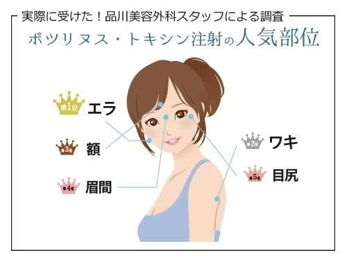 実際に受けた！品川美容外科スタッフによる調査 ボツリヌス・トキシン注射の人気部位 第1位：エラ 第2位：ワキ 第3位：額 第4位：眉間 第5位：目尻