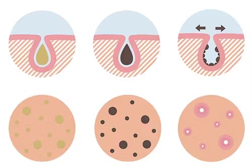 代表的な毛穴のトラブルは「つまり」「黒ずみ」「開き」
