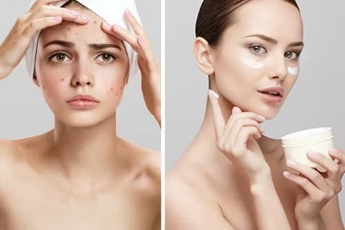 毛穴の詰まり・黒ずみ・開きの正しいケア方法とは？