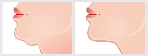 フェイスライン