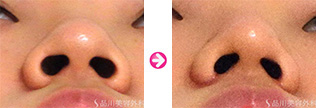 スーパーナチュラル鼻先修整&スーパーナチュラル小鼻縮小
