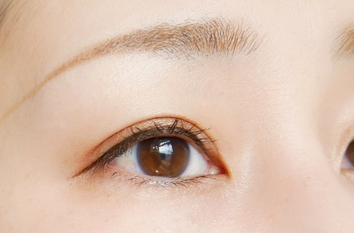 二重整形の種類とダウンタイム