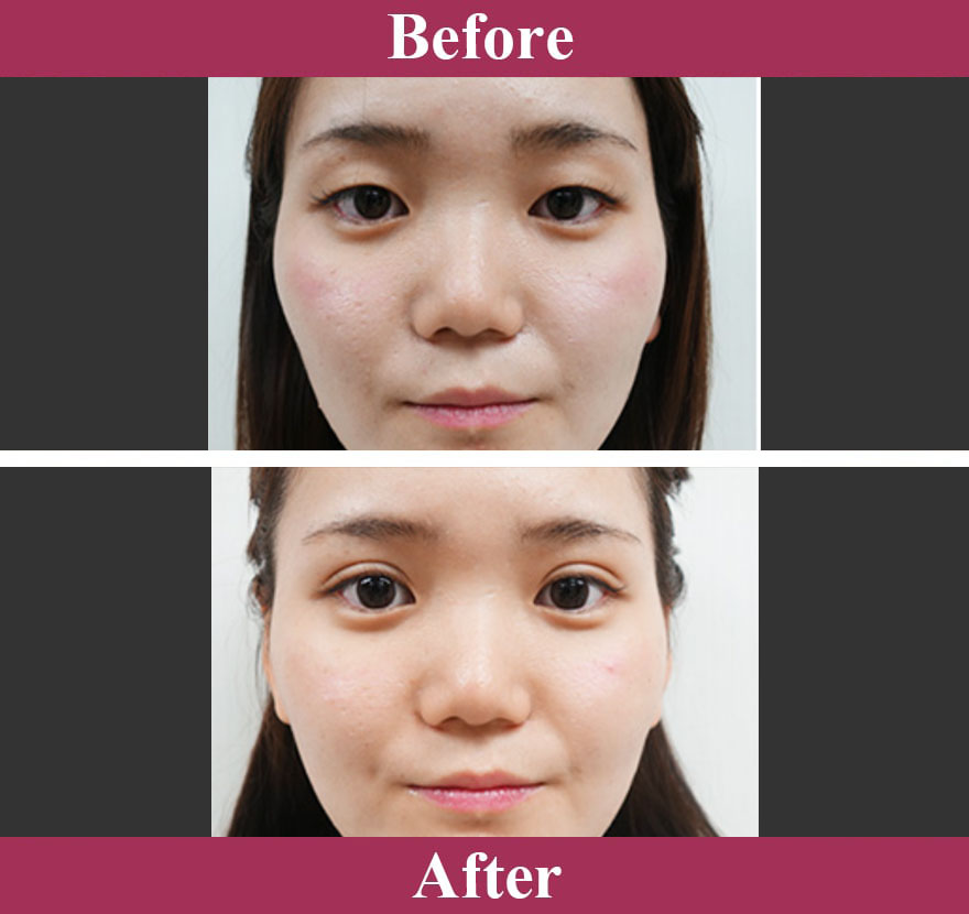 二重術ナチュラル法（二重埋没法） 症例写真【画像】