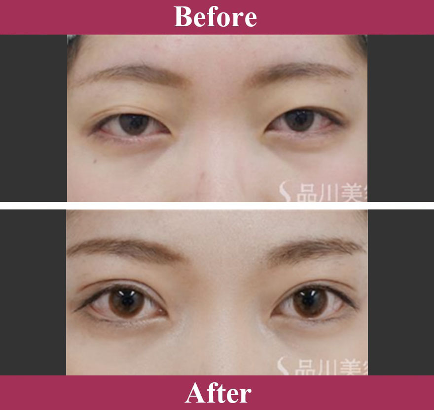 二重術エバーナチュラル法（埋没法） 症例写真【画像】