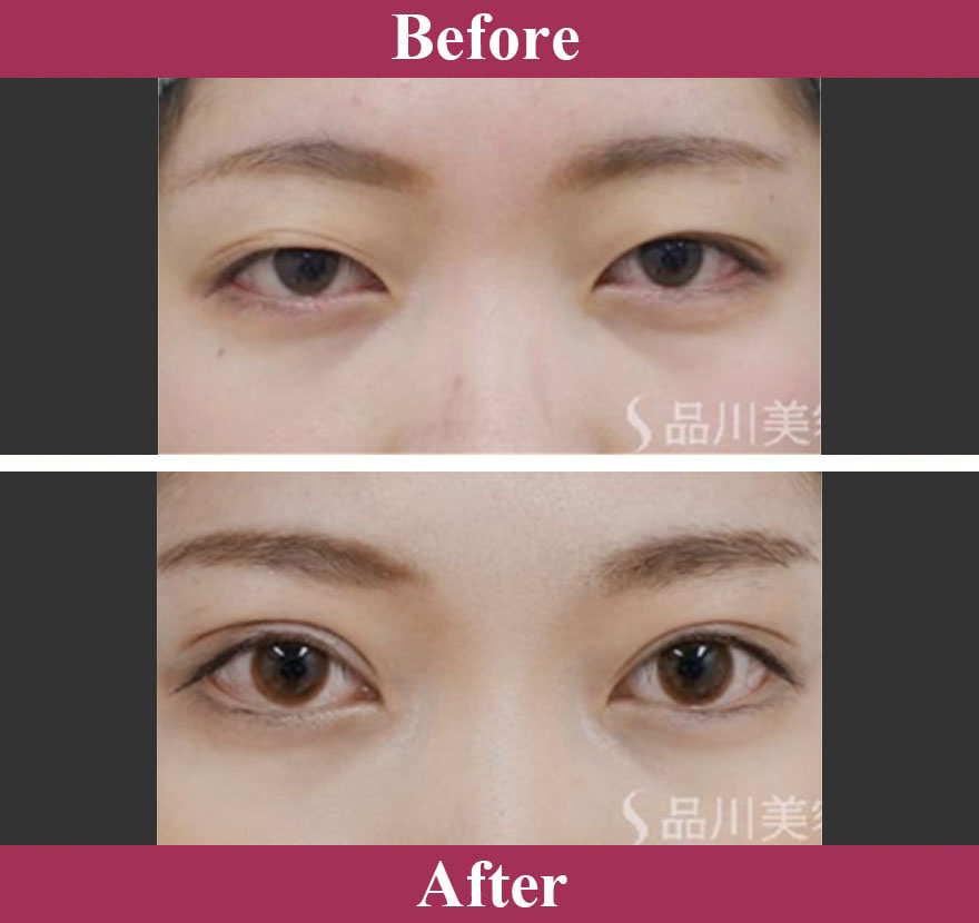 二重術エバーナチュラル法（埋没法） 症例写真【画像】