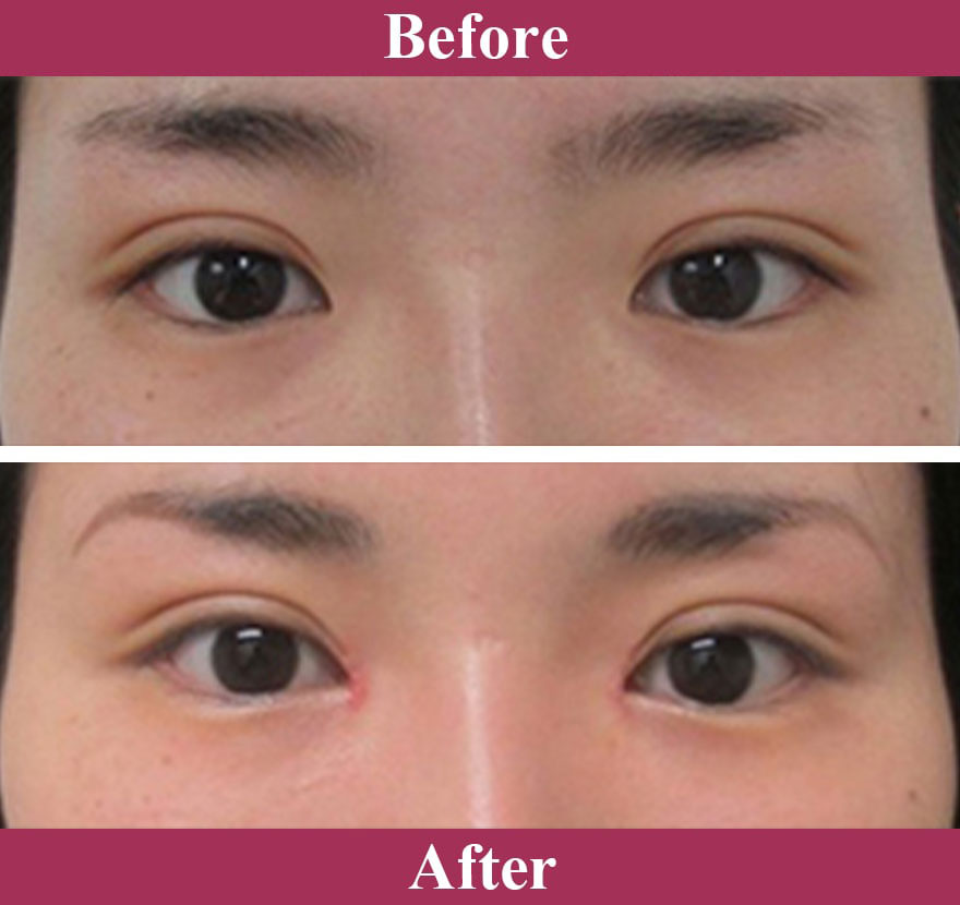 スーパーナチュラル目頭切開法 症例写真【画像】