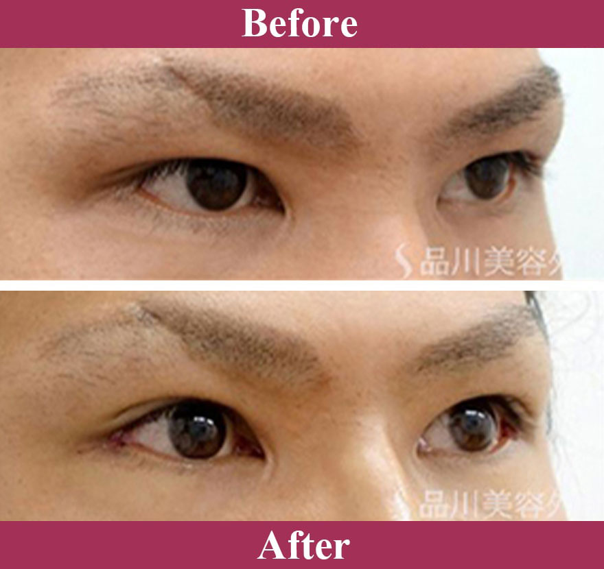 スーパーナチュラル目尻切開法 症例写真【画像】