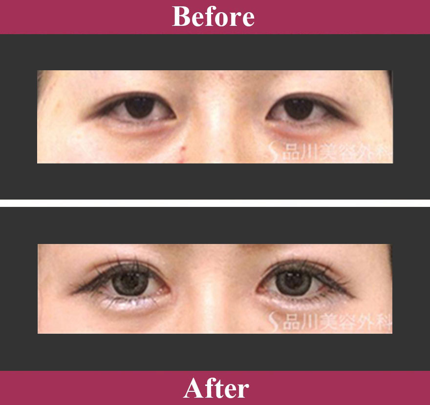 スーパーナチュラル目尻切開法 症例写真【画像】