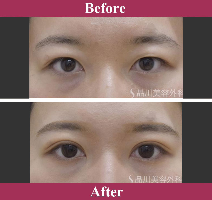 二重術エバーナチュラル法（埋没法） 症例写真【画像】