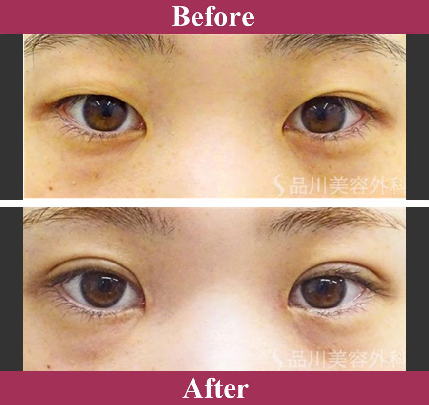 二重術切開法 症例写真【画像】