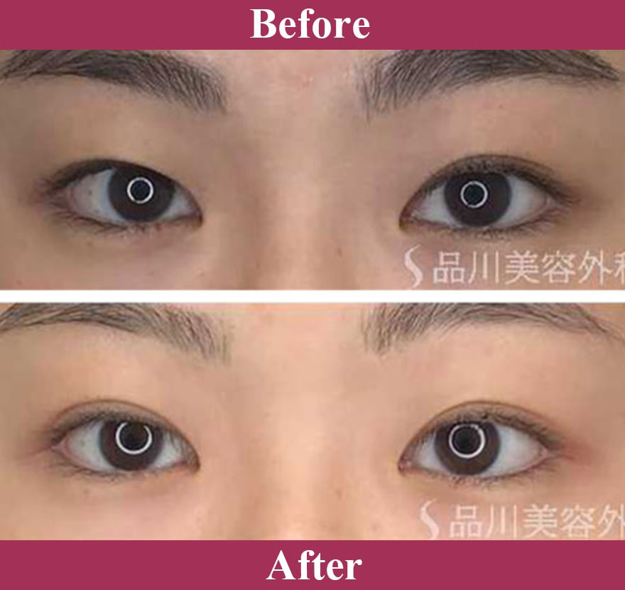 二重術ナチュラル法（二重埋没法） 症例写真【画像】