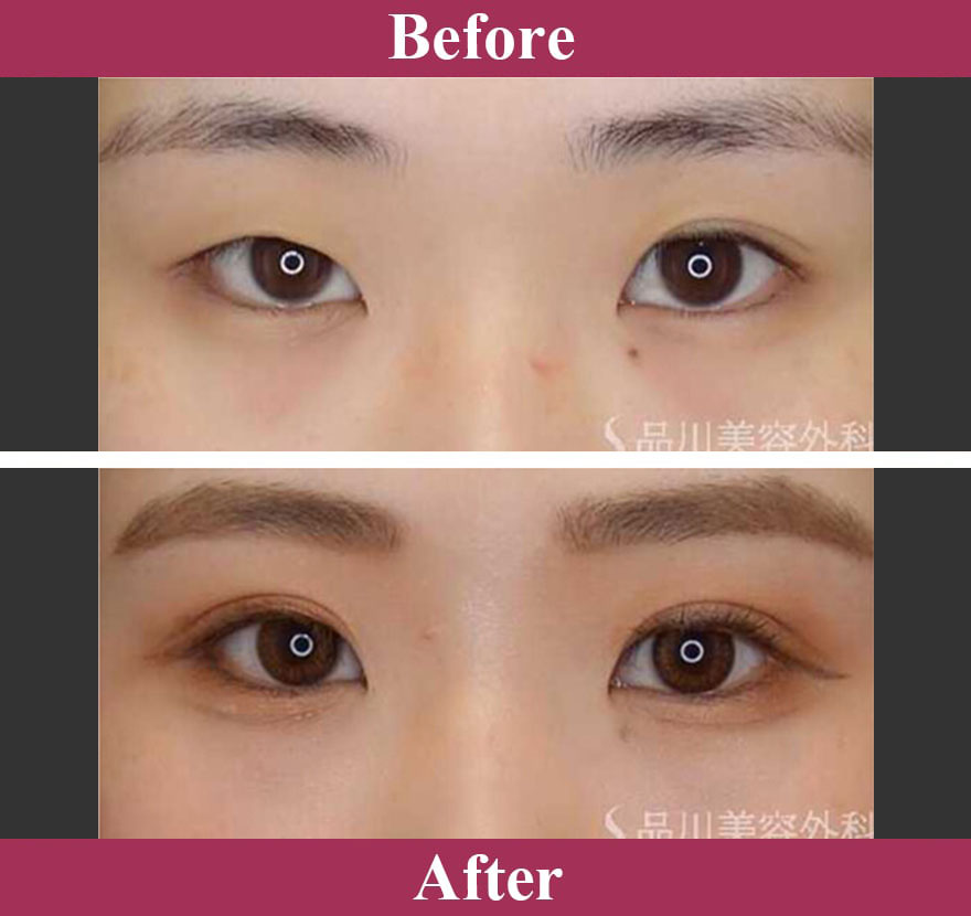 二重術ナチュラル法（二重埋没法） 症例写真【画像】