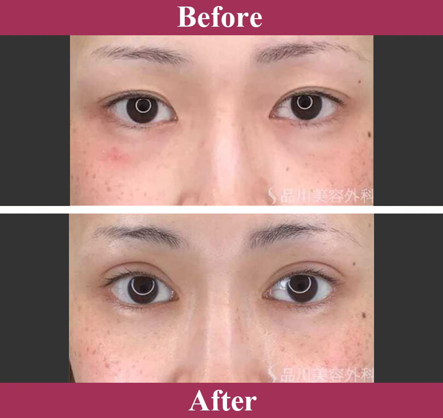 二重術切開法 症例写真【画像】