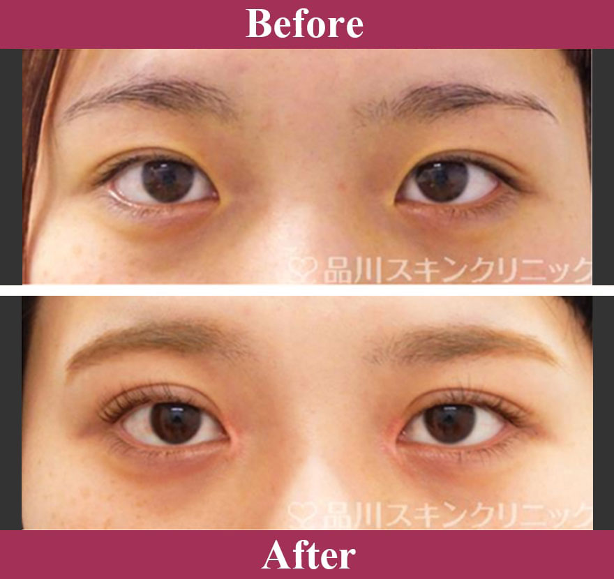 二重術切開法 症例写真【画像】