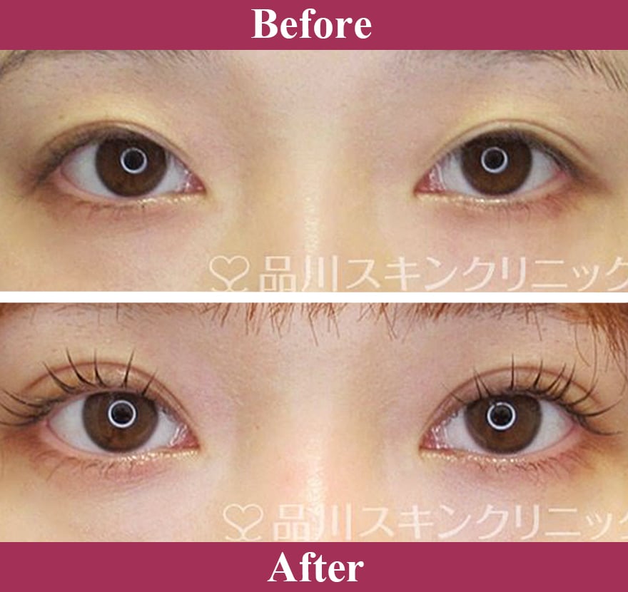 二重術エバーナチュラル法（埋没法）症例写真【画像】