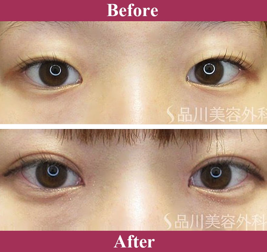 二重術エバーナチュラル法（埋没法）症例写真【画像】