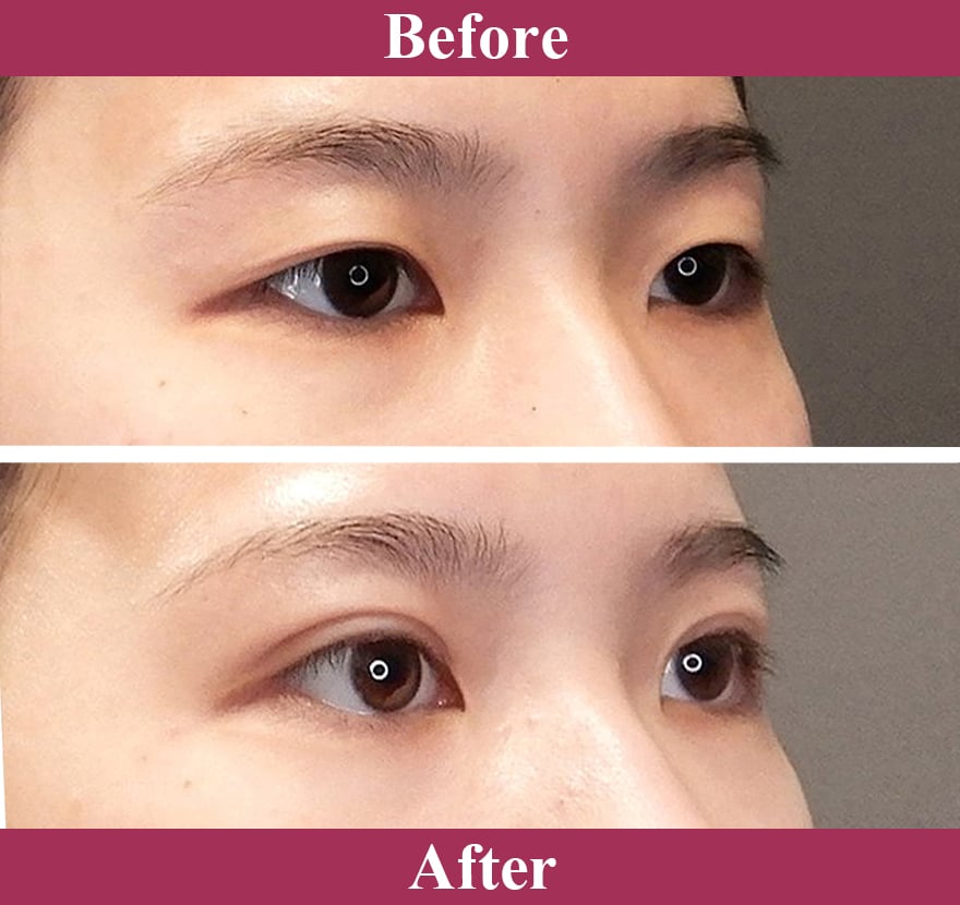 二重術エバーナチュラル法（埋没法）症例写真【画像】