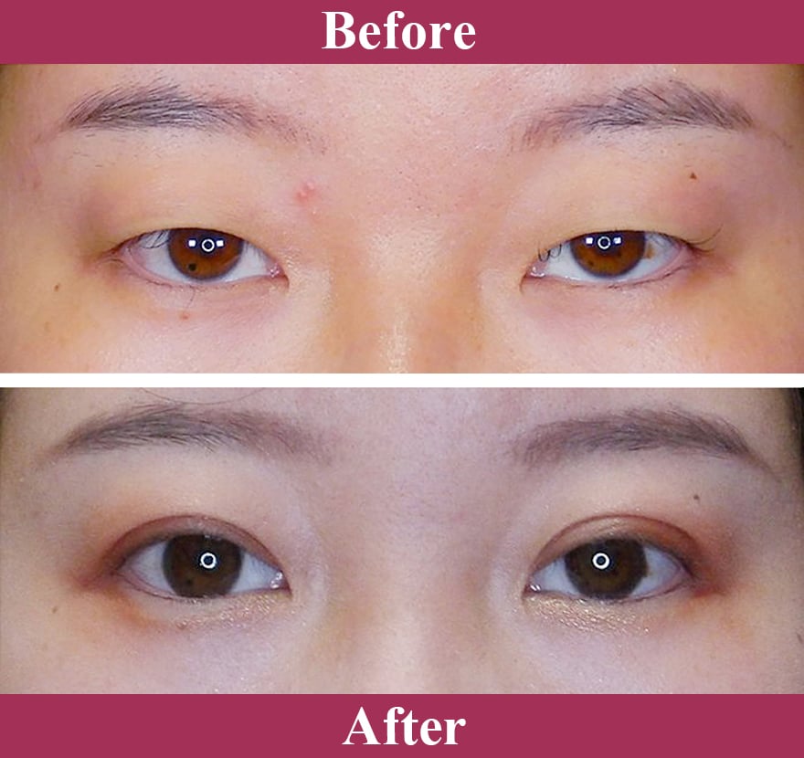 二重術エバーナチュラル法（埋没法）症例写真【画像】