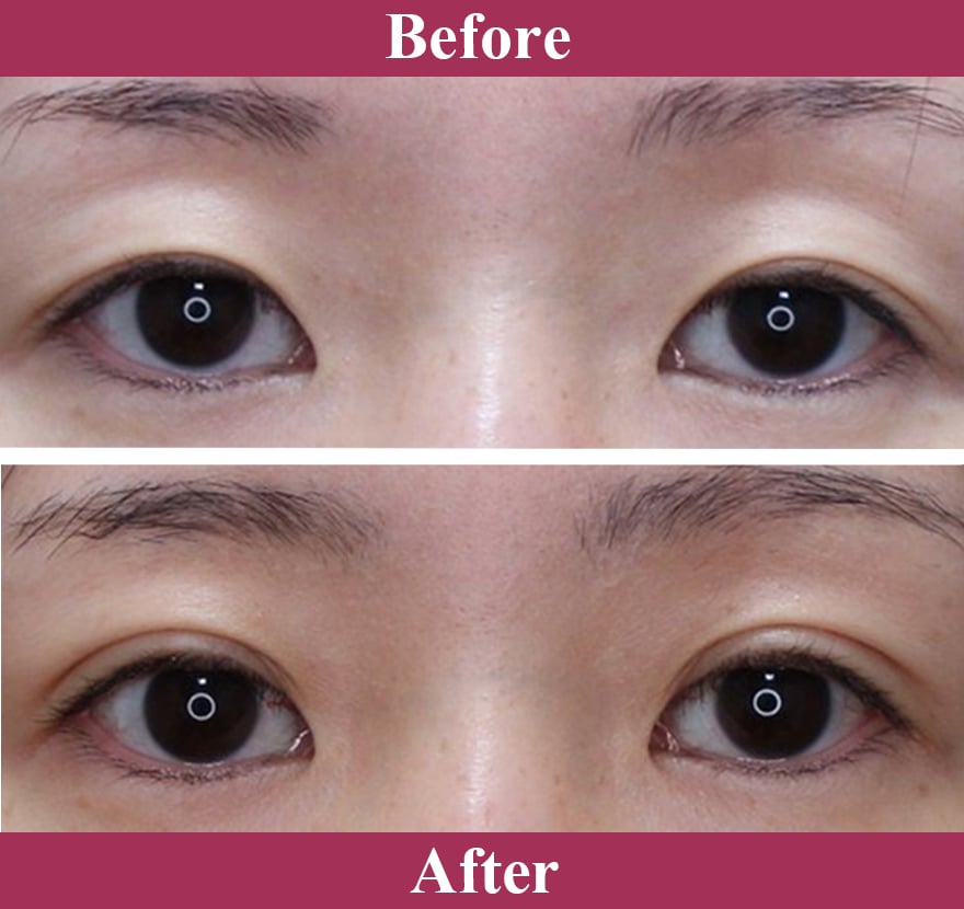 二重術エバーナチュラル法（埋没法）症例写真【画像】