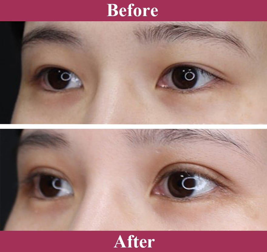 二重術エバーナチュラル法（埋没法）症例写真【画像】