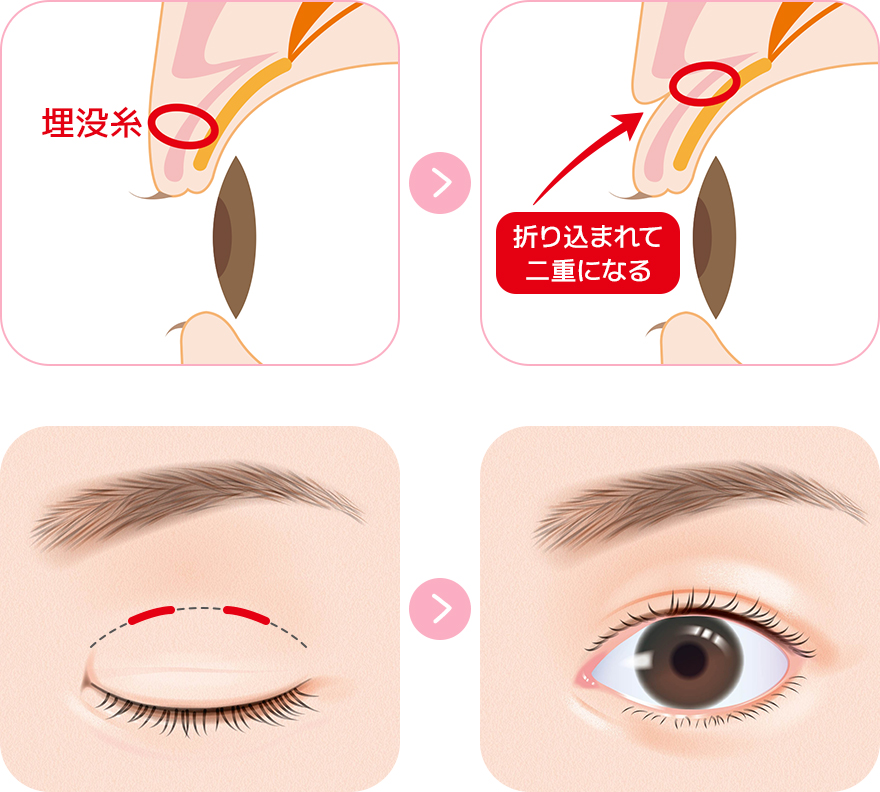自然な仕上がりの切らない二重術 埋没法とは