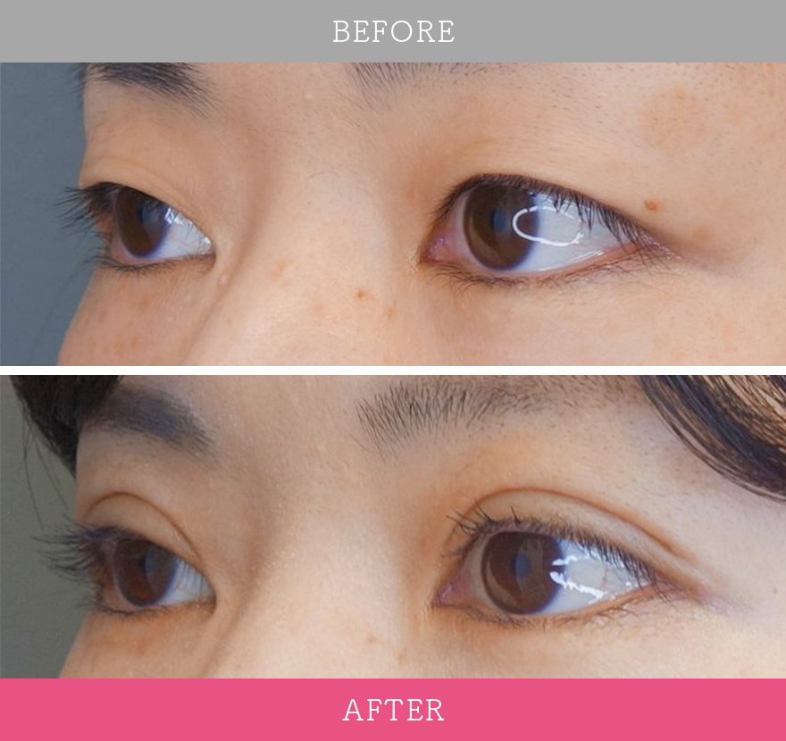 二重術ナチュラル法 症例写真