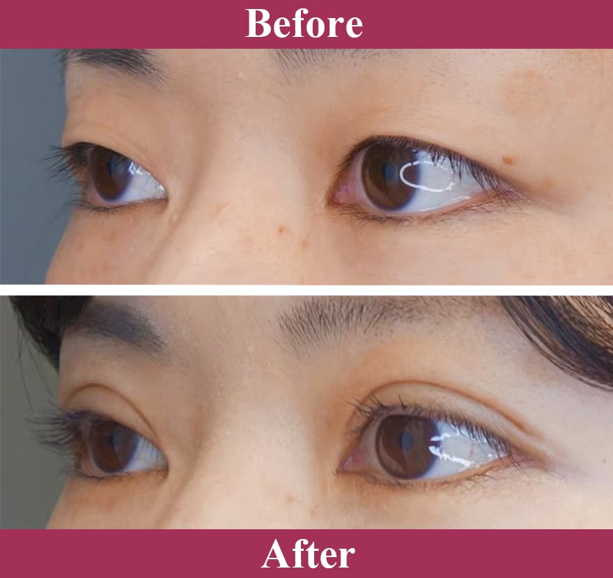 二重術ナチュラル法 症例写真