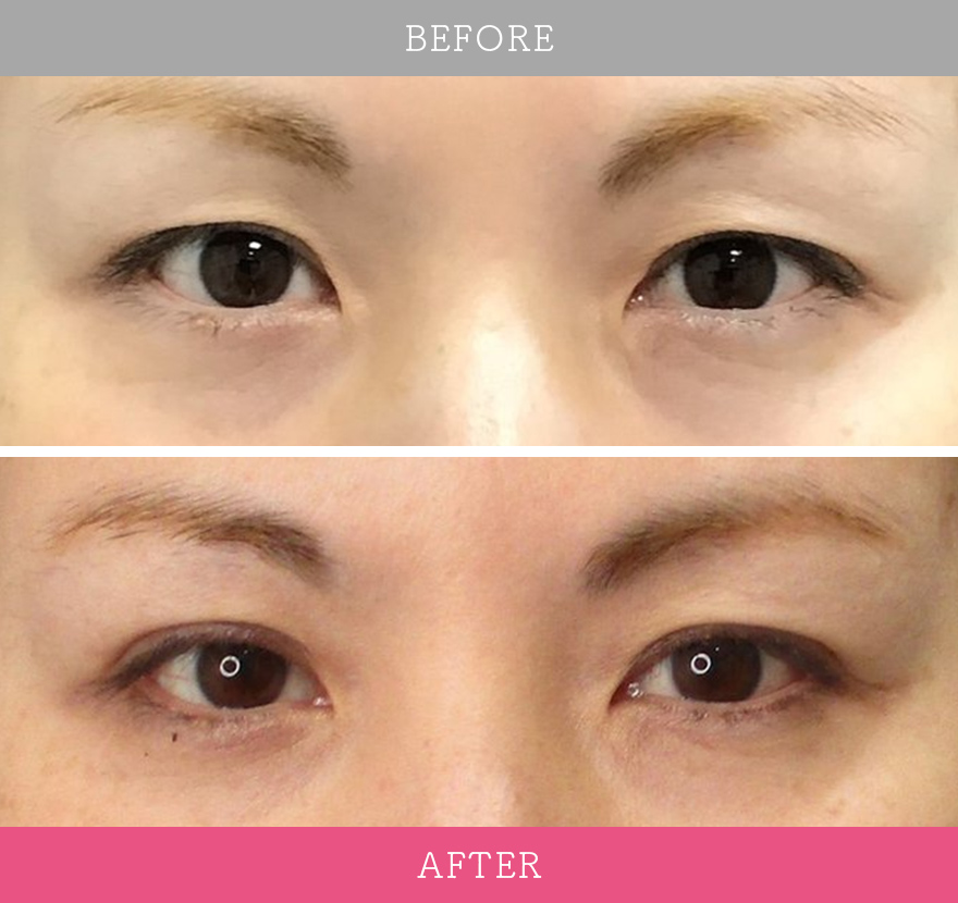 二重術ナチュラル法 症例写真