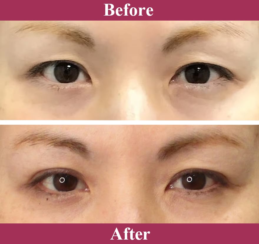 二重術ナチュラル法 症例写真