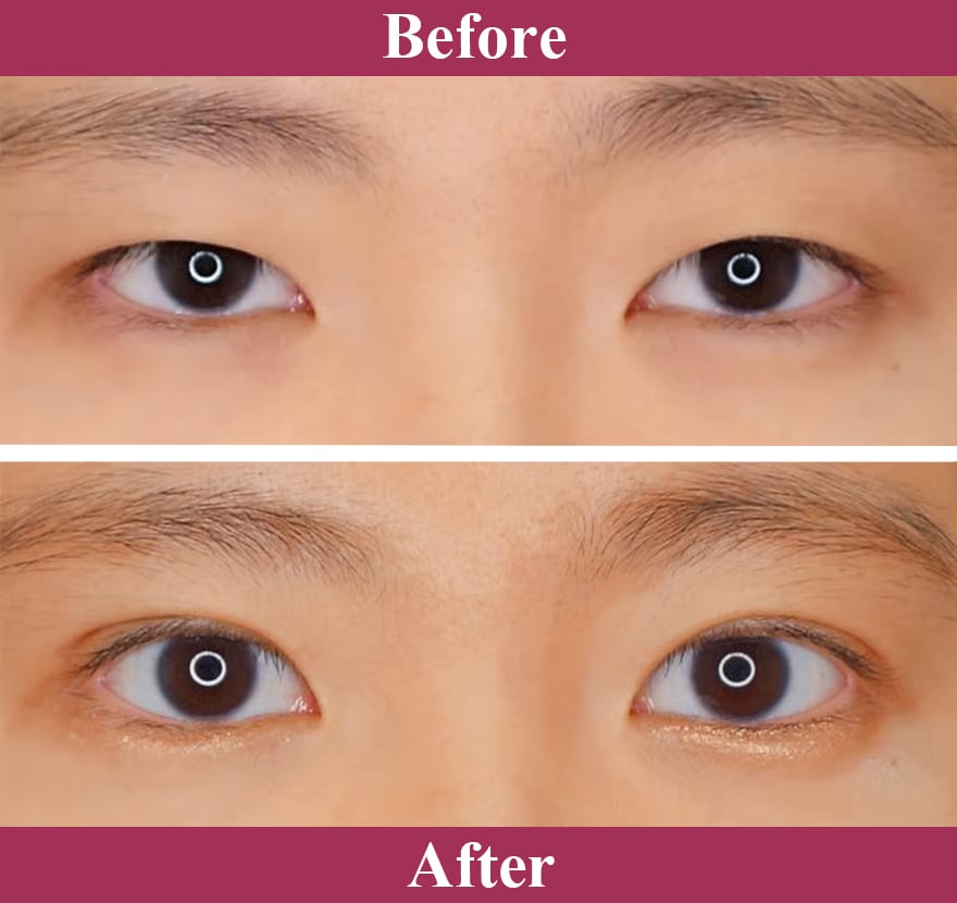 二重術ナチュラル法 症例写真