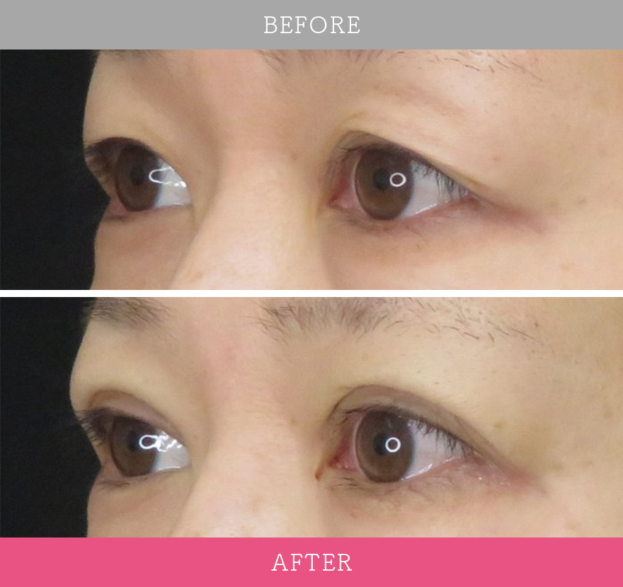 二重術ナチュラル法 症例写真