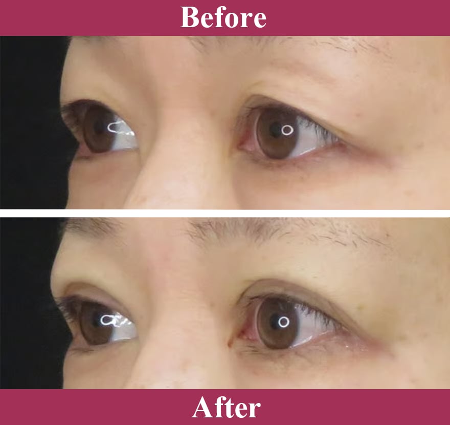 二重術ナチュラル法 症例写真