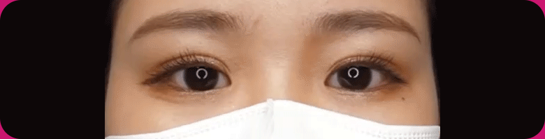 当院一番人気の埋没法!