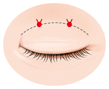 腫れやすい二重が取れやすい