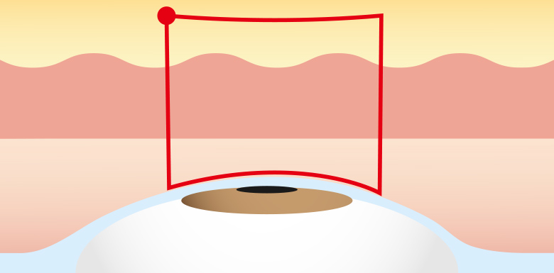 線留め方式（二重術ナチュラル法）