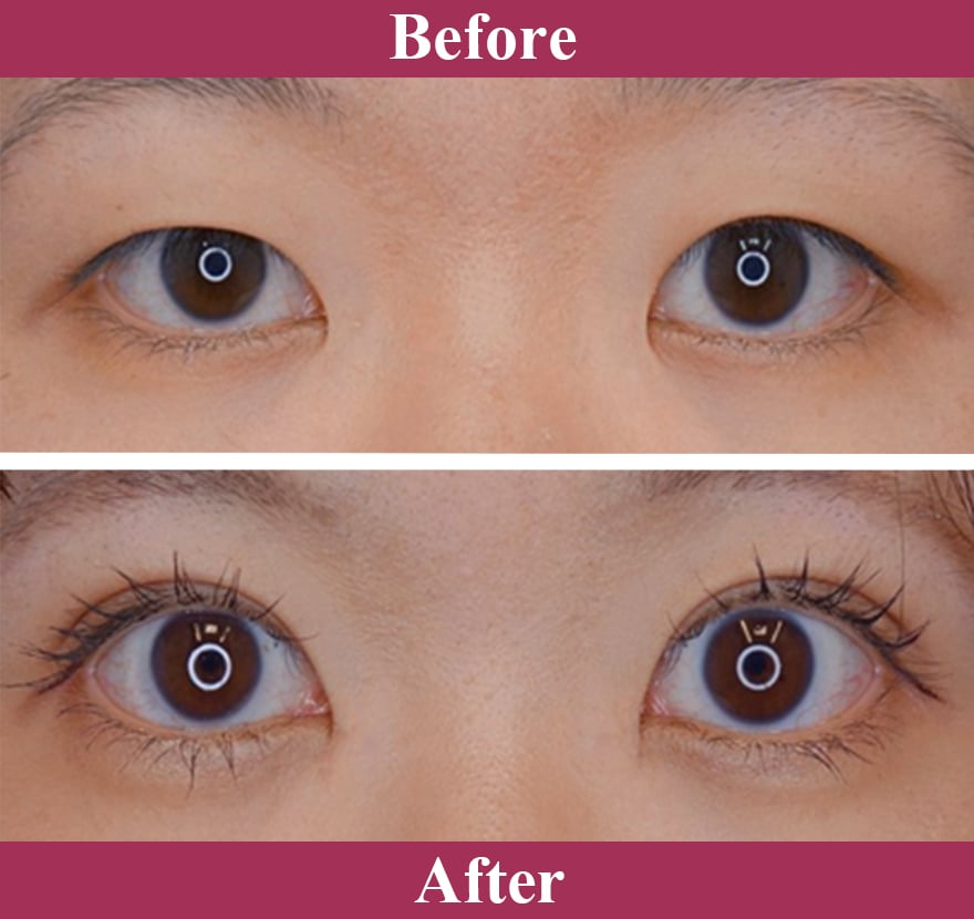 二重術エバーナチュラル法 症例写真