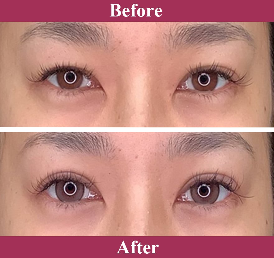 二重術エバーナチュラル法 症例写真