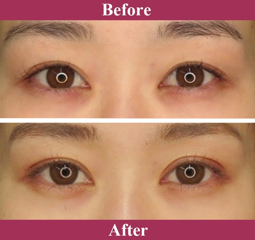 二重術エバーナチュラル法 症例写真