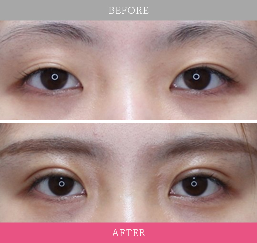 二重術エバーナチュラル法 症例写真