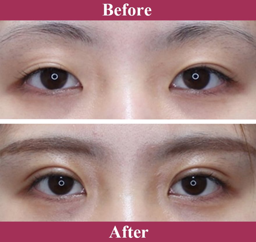 二重術エバーナチュラル法 症例写真