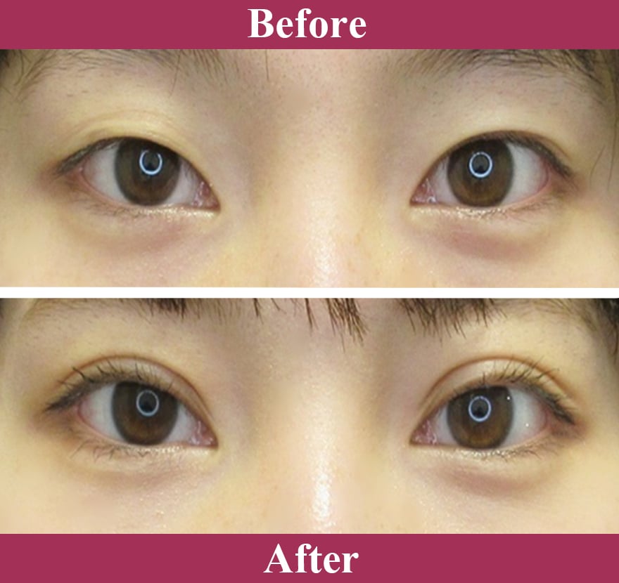 二重術エバーナチュラル法 症例写真