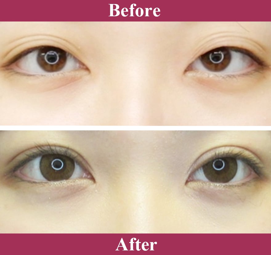 二重術エバーナチュラル法 症例写真