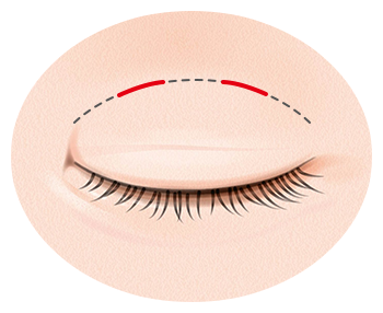 腫れが少ない二重が取れにくい