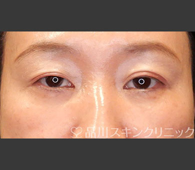 切らないクマ取り 症例写真